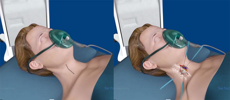 anterior-cervical-corpectomy