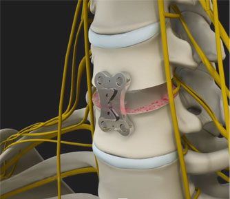 anterior-cervical-discectomy