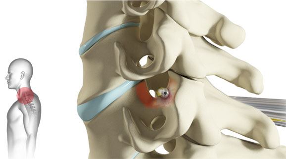 cervical-foraminotomy