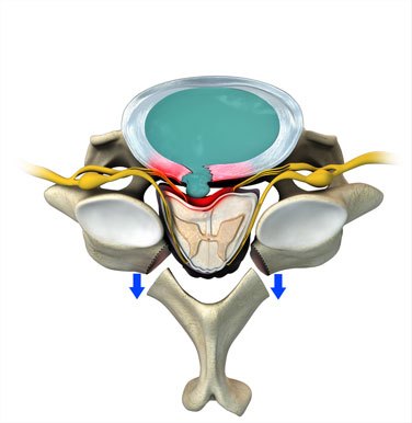 cervical-laminectomy