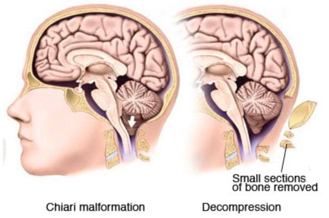 chiari-malformation