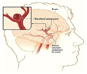 clipping-anterior-cerebral-aneurysm