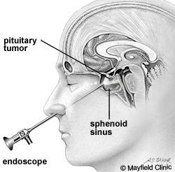 endoscopic-pituitary