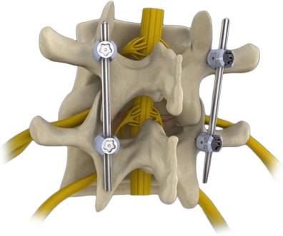 lumbar-decompression-and-pedicle-screw