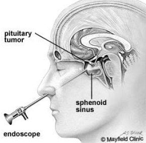 transsphenoidal-removal-for-pituitary